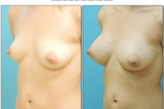Breast-augmentation.017