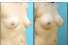 Breast-augmentation.018