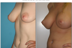 Breast-augmentation.020