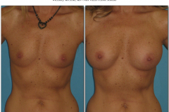 Breast-augmentation.021