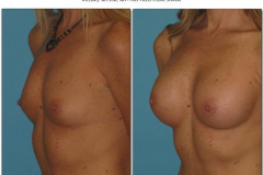 Breast-augmentation.022