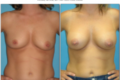 Breast-augmentation.023
