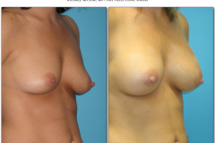 Breast-augmentation.024
