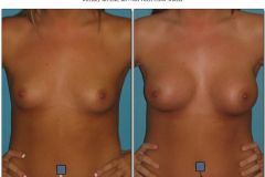 Breast-augmentation.025