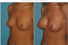 Breast-augmentation.026