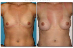 Breast-augmentation.027