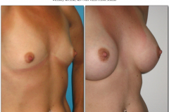 Breast-augmentation.028