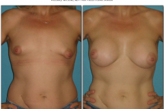 Breast-augmentation.029