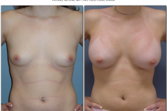 Breast-augmentation.030