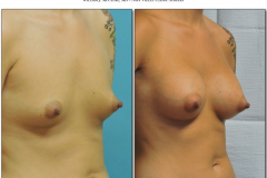 Breast-augmentation.032