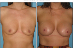 Breast-augmentation.034