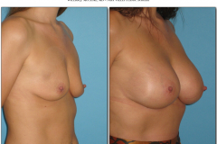 Breast-augmentation.035
