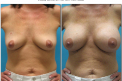 Breast-augmentation.036