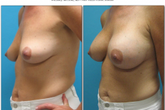 Breast-augmentation.037