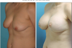 Breast-augmentation.040