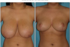 Dr. McClure - Breast Lift / Reduction