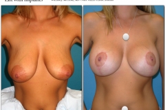 Breast-lift-reduction-006