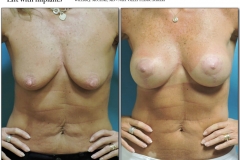 Breast-lift-reduction-007
