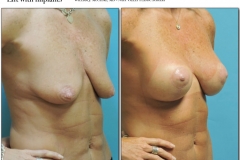 Breast-lift-reduction-008