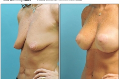 Breast-lift-reduction-009