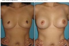 Breast-lift-reduction-010