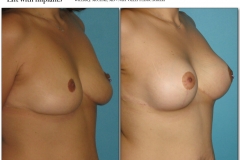Breast-lift-reduction-011