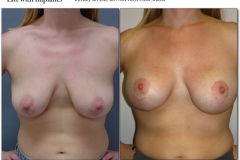 Breast-lift-reduction-012
