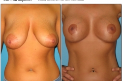 Breast-lift-reduction-013