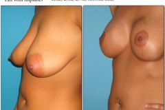 Breast-lift-reduction-014