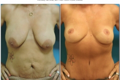 Breast-lift-reduction-7
