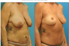 Breast-lift-reduction-8