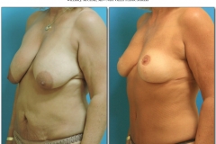 Breast-lift-reduction-9