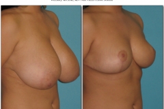 Breast-lift-reduction-Before-After.002
