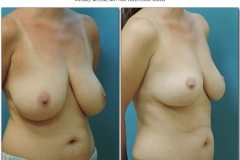 Breast-lift-reduction-Before-After.004