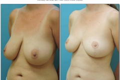 Breast-lift-reduction-Before-After.005