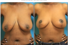 Breast-lift-reduction-Before-After.006