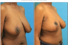 Breast-lift-reduction-Before-After.007