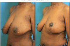 Breast-lift-reduction-Before-After.008