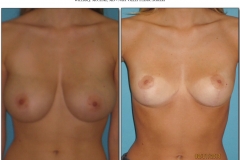 Breast-lift-reduction-Before-After.009