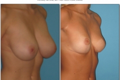 Breast-lift-reduction-Before-After.010