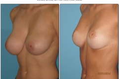 Breast-lift-reduction-Before-After.011