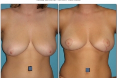 Breast-lift-reduction-Before-After.012