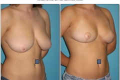 Breast-lift-reduction-Before-After.013