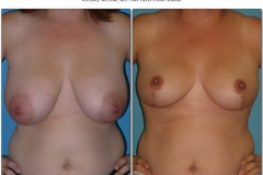 Breast-lift-reduction-Before-After.014