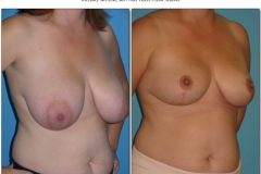 Breast-lift-reduction-Before-After.015