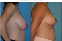 Breast-lift-reduction-Before-After.016