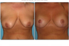 Breast-lift-reduction-Before-After.017