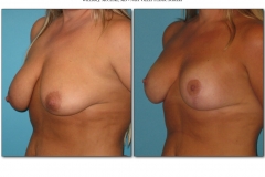 Breast-lift-reduction-Before-After.018
