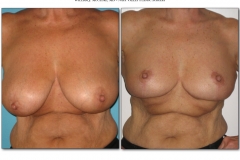Breast-lift-reduction-Before-After.019
