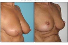 Breast-lift-reduction-Before-After.020